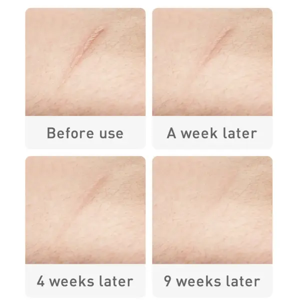 Acne and Scar Removal Cream - Image 6