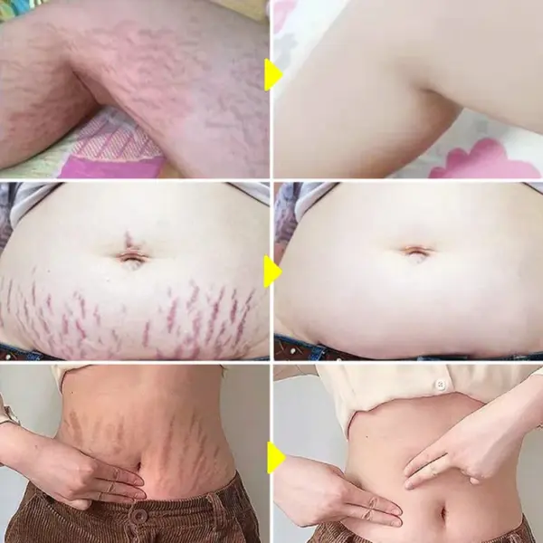 Stretch Marks Repair Body Lotion - Image 3